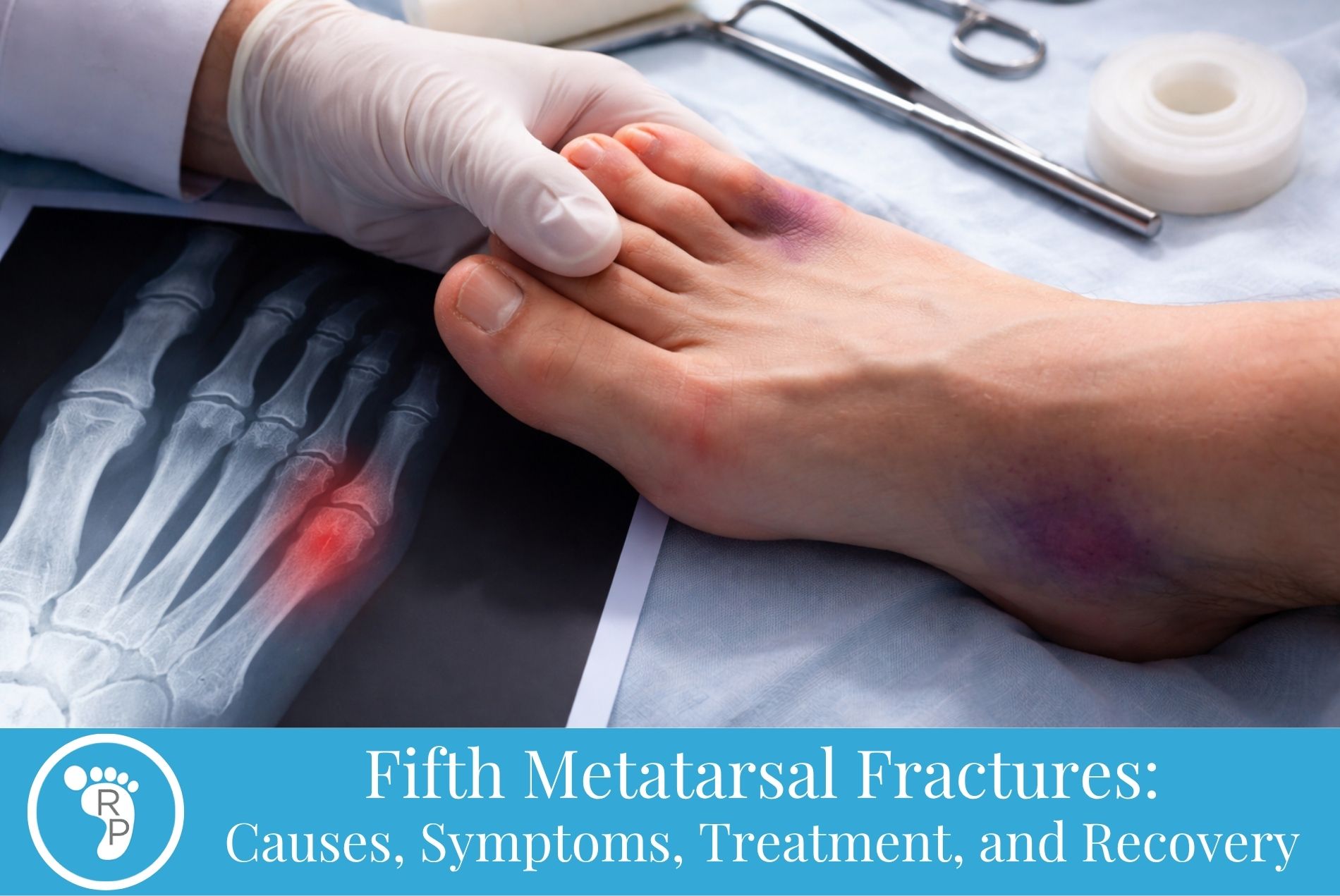 Fifth Metatarsal Fractures